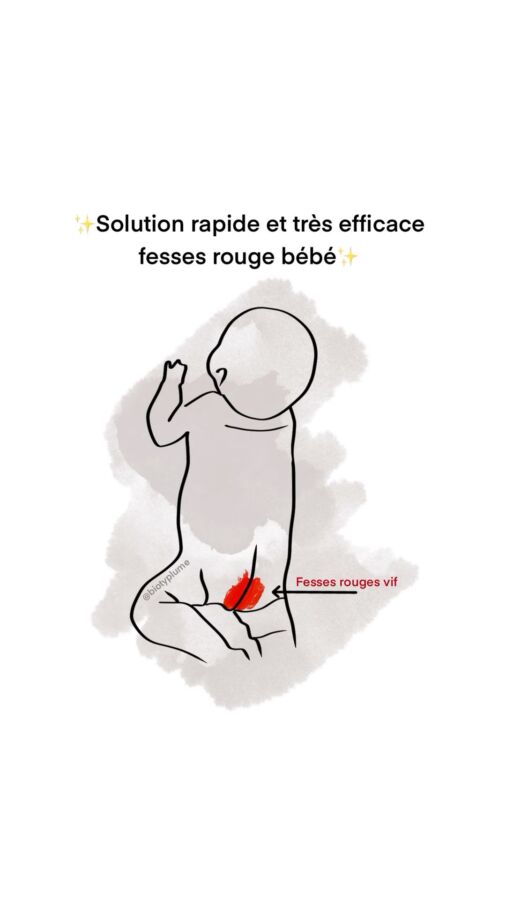érythème fessier
